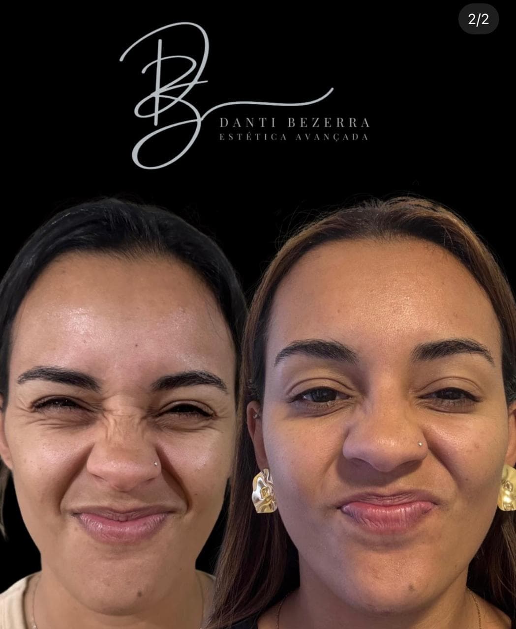 Registro 2: comparação antes e depois de atendimento com toxina botulínica