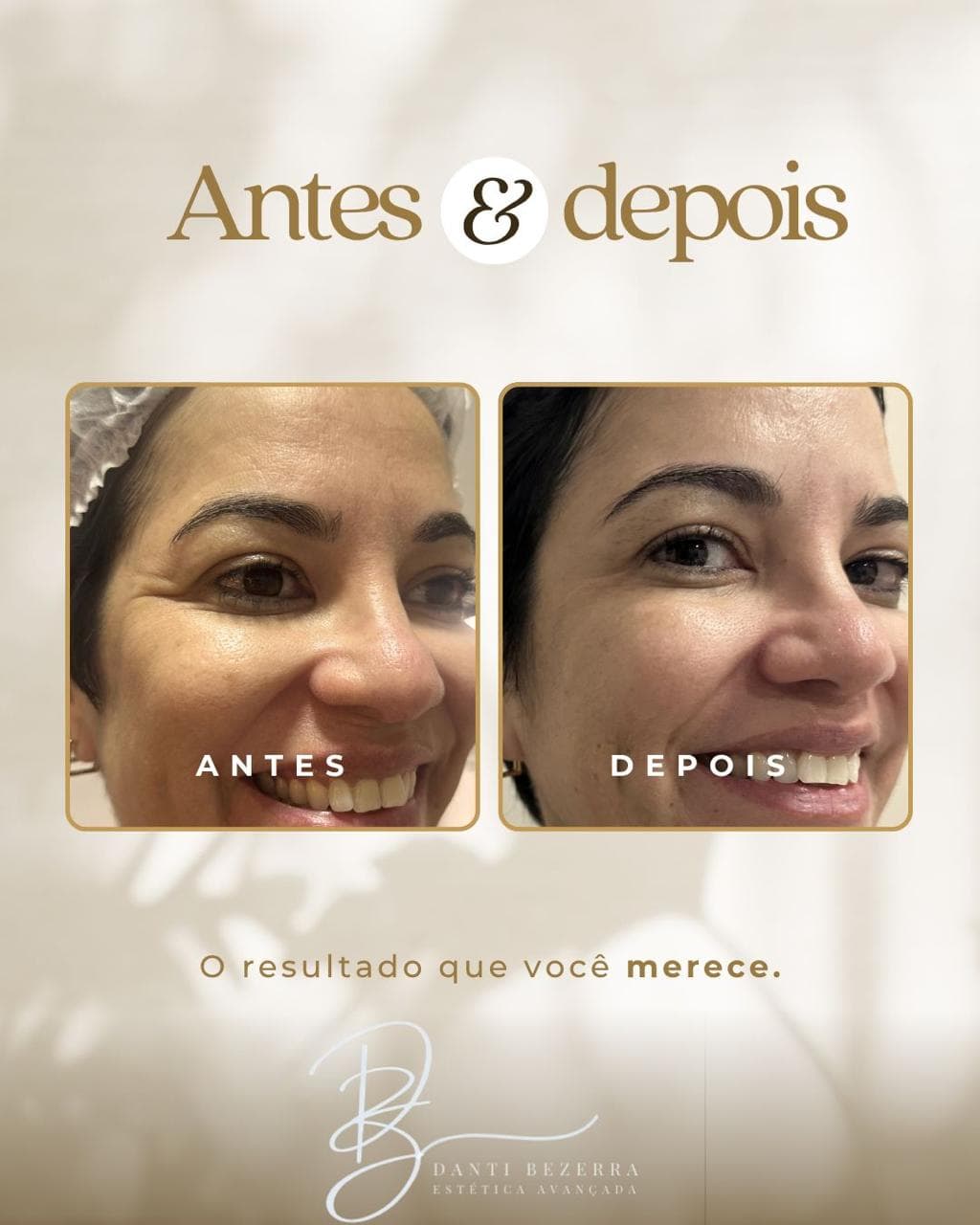 Registro 8: comparação antes e depois de atendimento com toxina botulínica