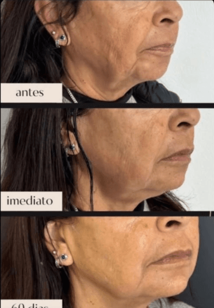 Evolução antes, imediato e 60 dias no contorno facial com HIPRO
