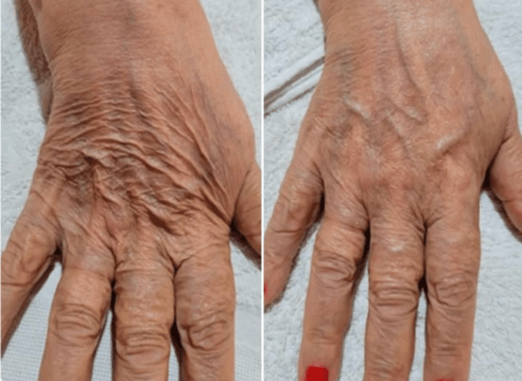 Antes e depois imediato no dorso da mão com HIPRO