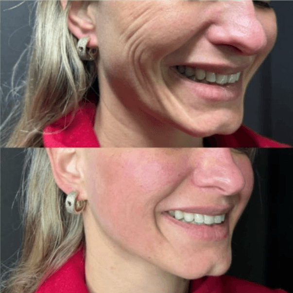 Antes e depois de firmeza facial com HIPRO