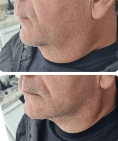Antes e depois de contorno de mandíbula e papada com HIPRO