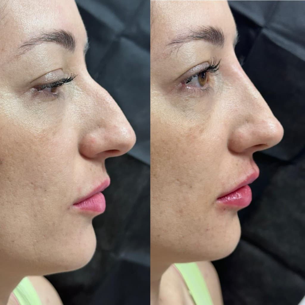 Antes e depois em perfil: rinomodelação e realce labial