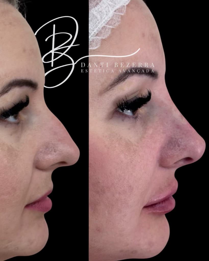 Antes e depois em perfil: nariz e lábios com definição