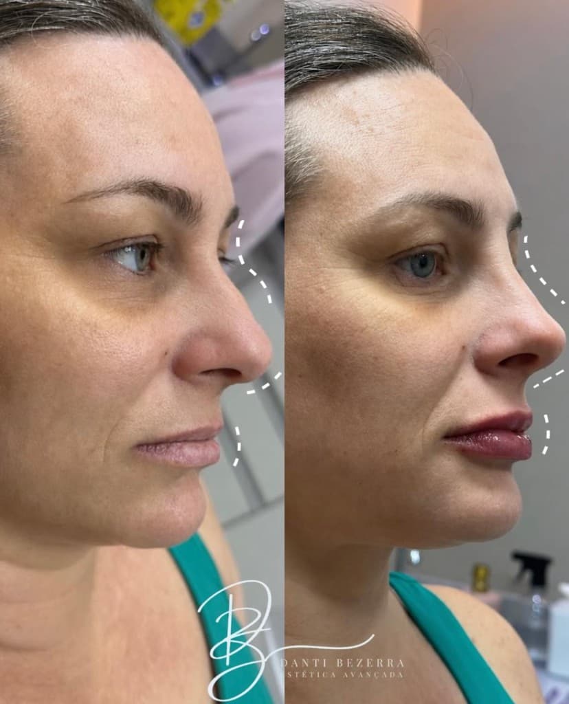 Antes e depois em perfil: harmonização de nariz e lábios